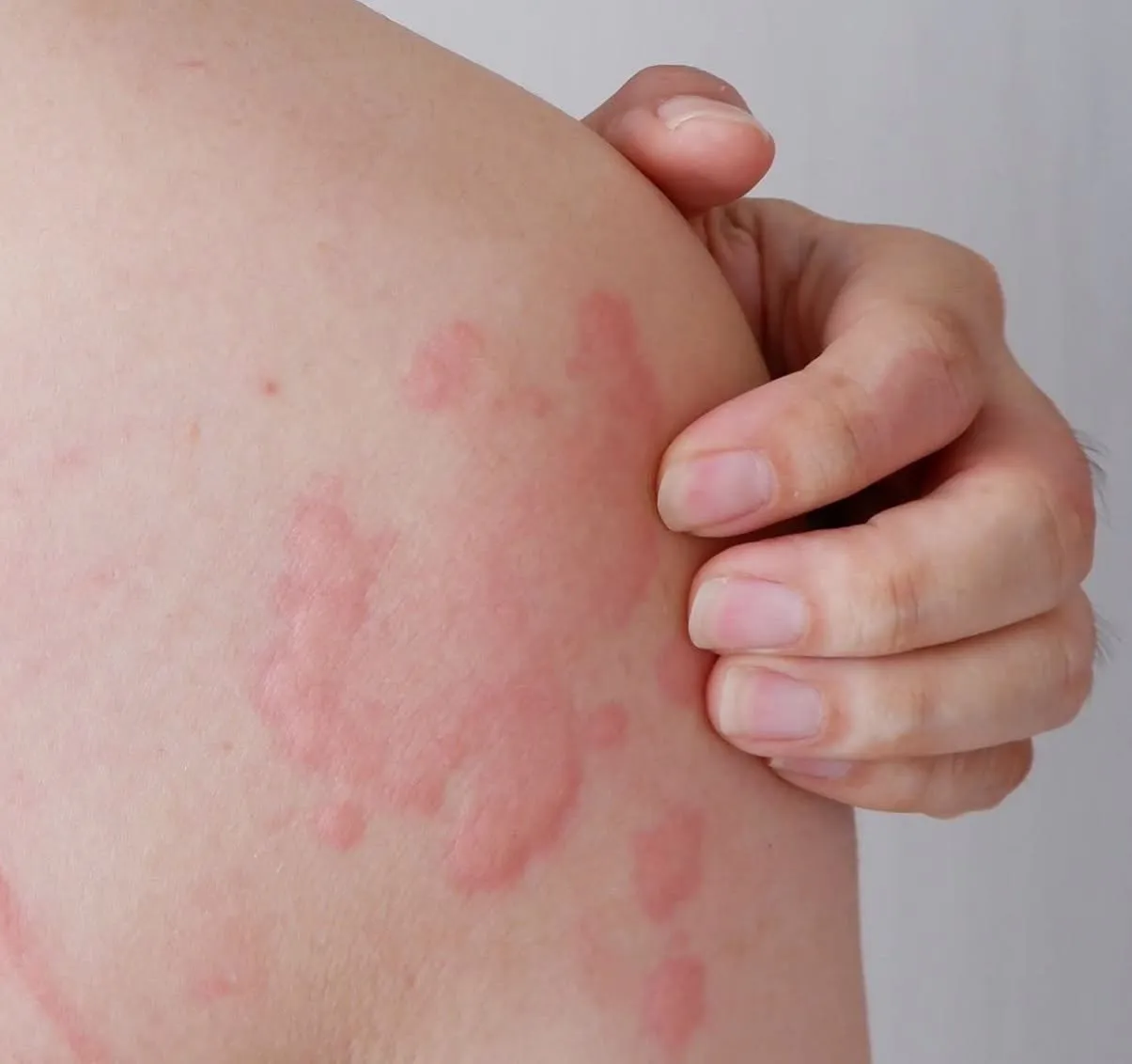 Ce este urticaria! Care sunt cauzele și când devine periculoasă pentru sănătate